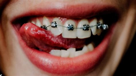 how to kiss with braces|do braces affect kissing.